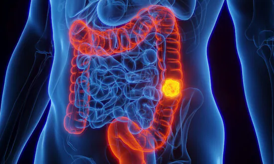 Aggressive Colorectal Cancer Tied to Oral Bacterium