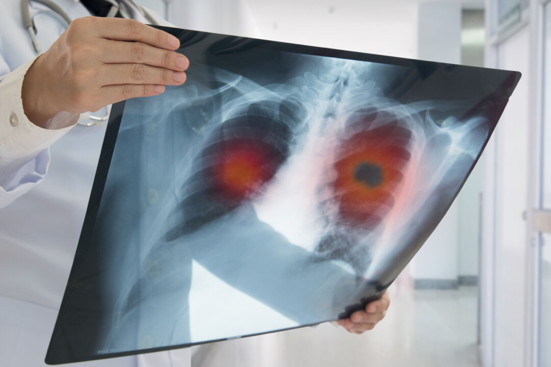 Adenocarcinoma often begins along the outer parts of the lungs and is the most common type of cancer in people who have never smoked. (Shutterstock)