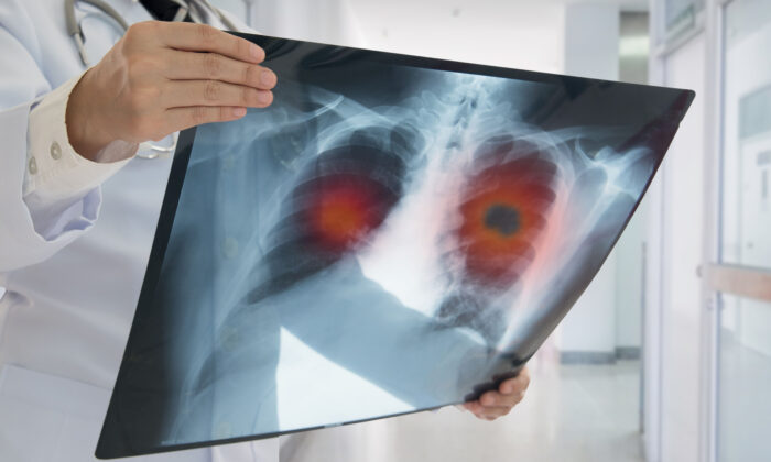 Lung Cancer, 'Silent Killer', Still Curable If Detected Early