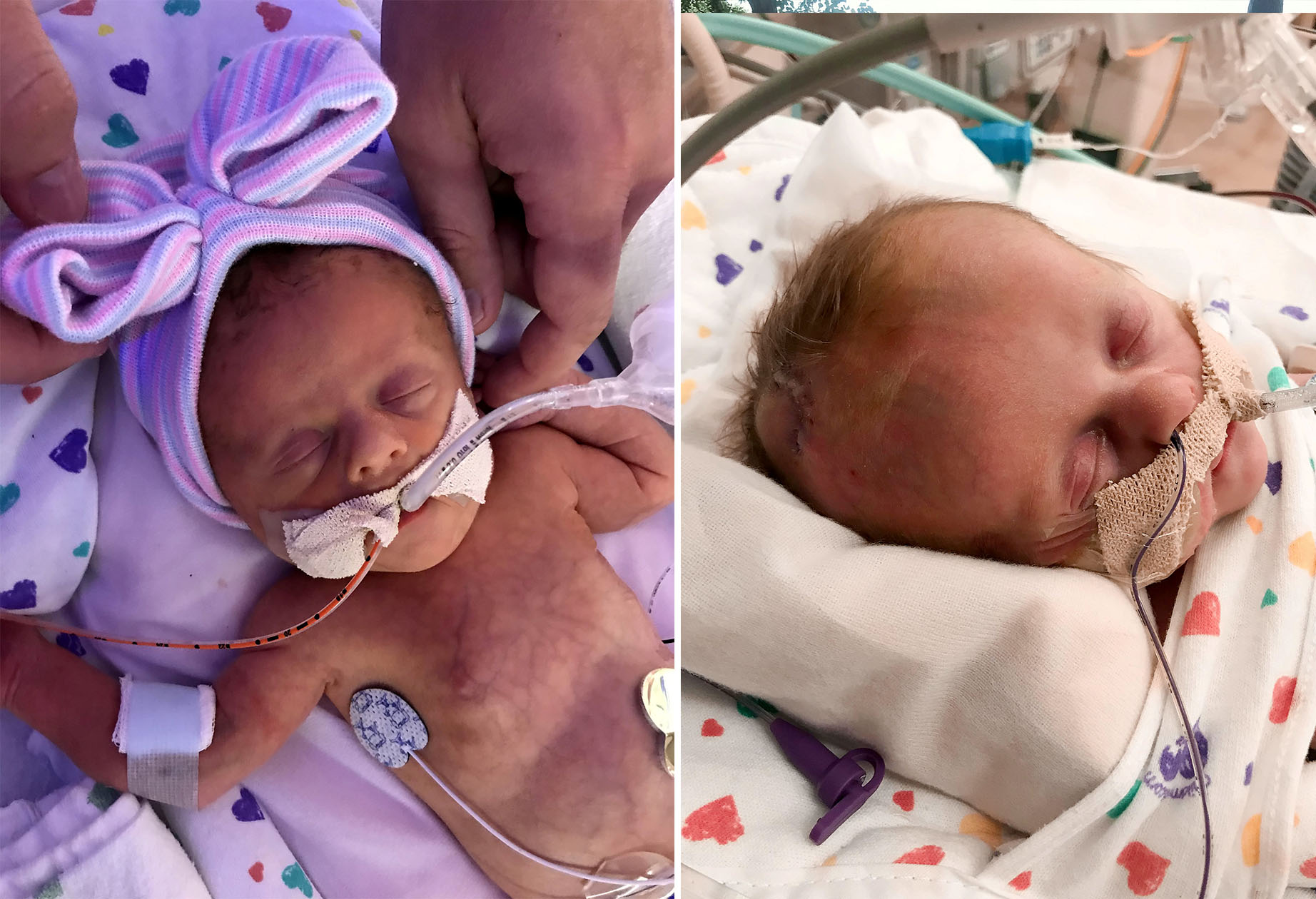 Baby Born 19 Weeks Early Defies Long Odds and Astonishes Doctors - The New  York Times