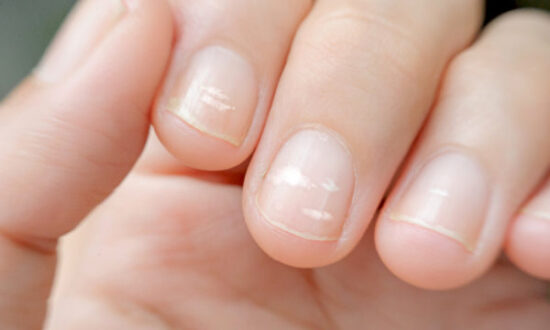 Observing Nails as Indicators of Health Imbalances