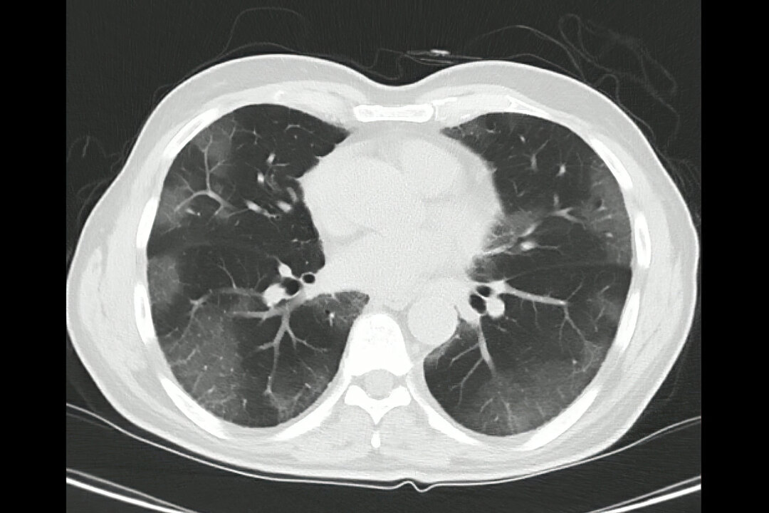 Computed Tomography of the chest in a confirmed case of COVID-19. Shutterstock