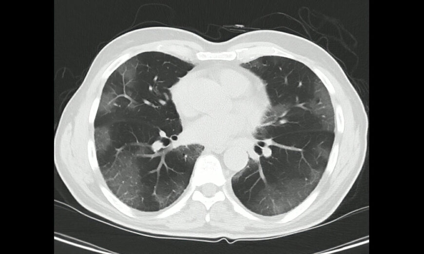 Computed Tomography of the chest in a confirmed case of COVID-19. Shutterstock