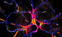Parkinson’s Disease May Be 50 Percent Underdiagnosed: Study