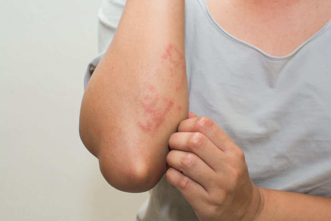 Study Finds Link Between Common Chemicals and Inflammatory Skin Disease