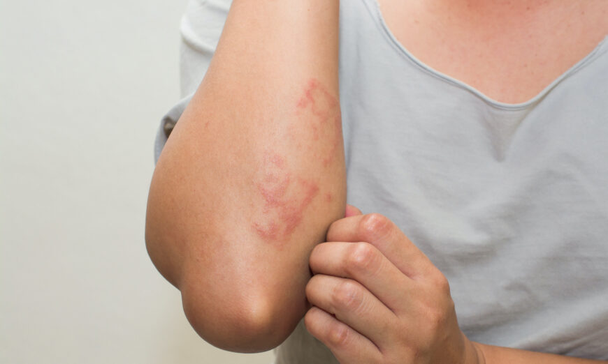 Common chemicals may be to blame for your eczema. (pumatokoh/Shutterstock)