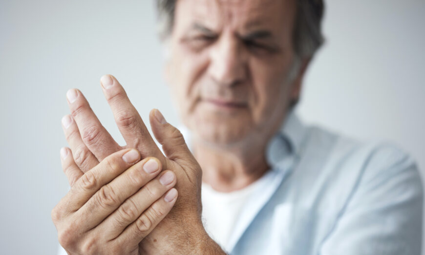 A repurposed drug may help hand osteoarthritis. (Shutterstock)