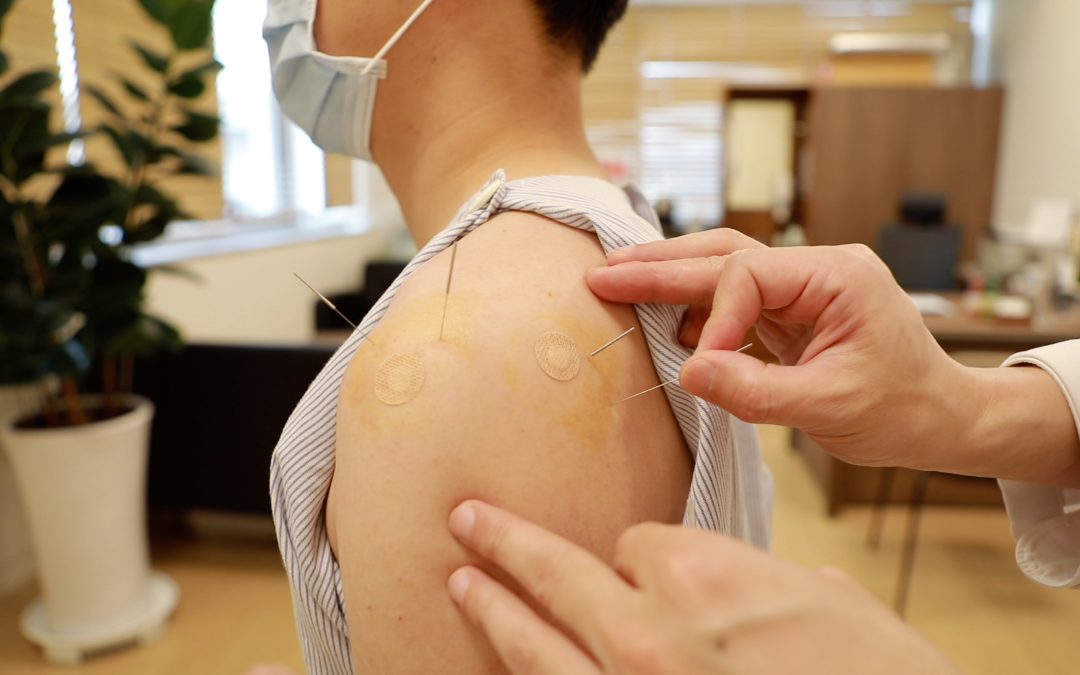 A patient receiving acupuncture treatment on the shoulder. (Courtesy of  Courtesy of Jaseng Hospital of Korean Medicine, South Korea)