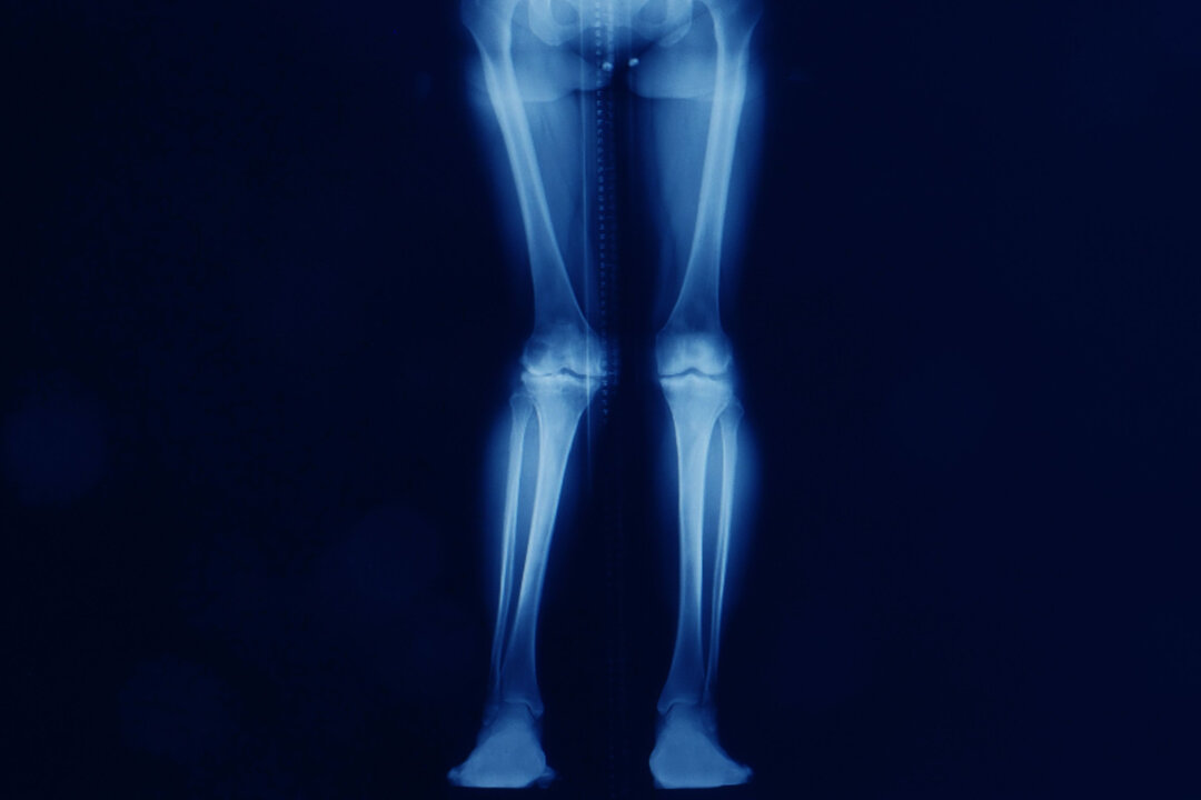 An X-ray of lower extremities showing hip, knee, and ankle joints. The right knee shows severe valgus malalignment or knock knee and osteoarthritis. (Yok_onepiece/Shutterstock)