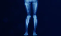 Causes and Treatments for Knock Knees