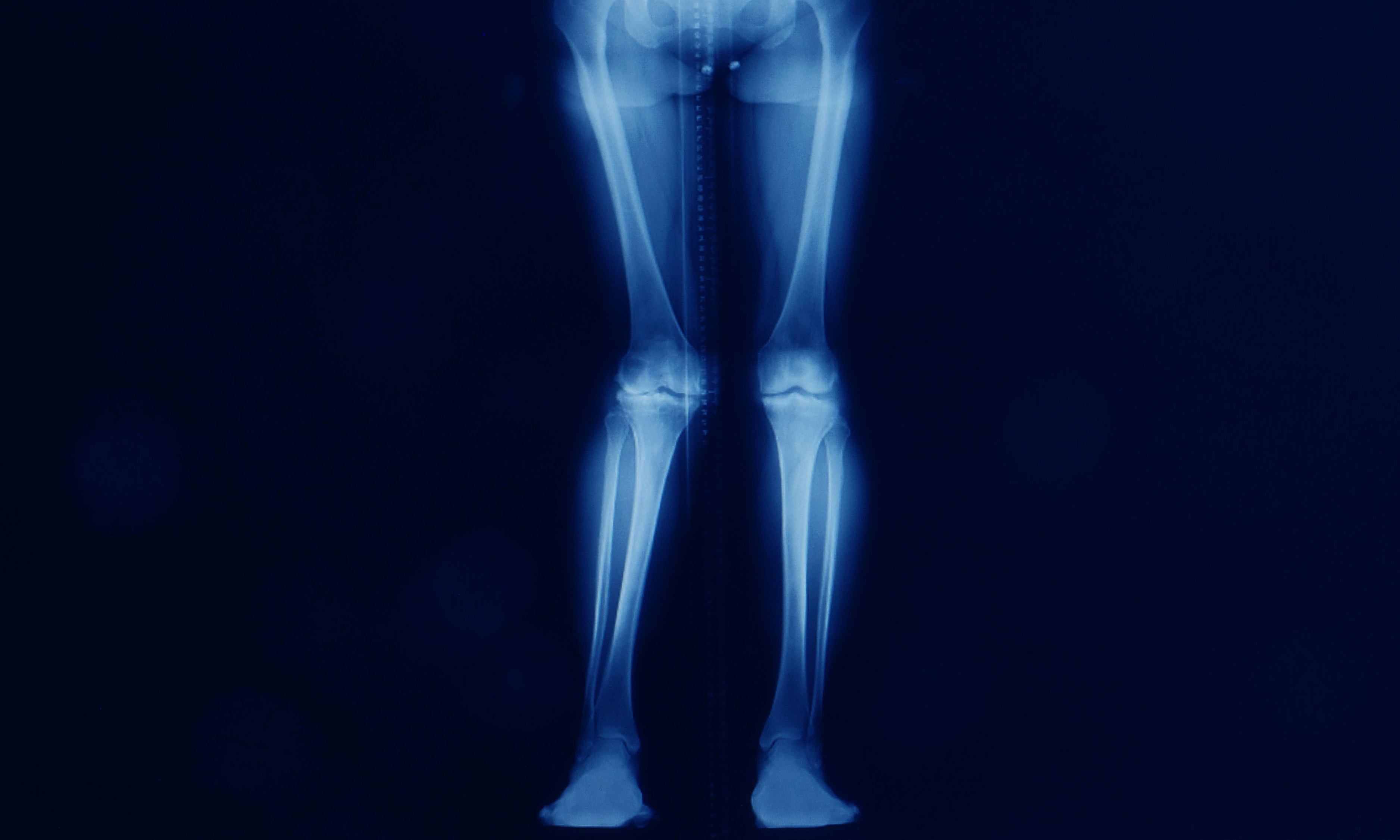 Causes and Treatments for Knock Knees - Vimarsana News