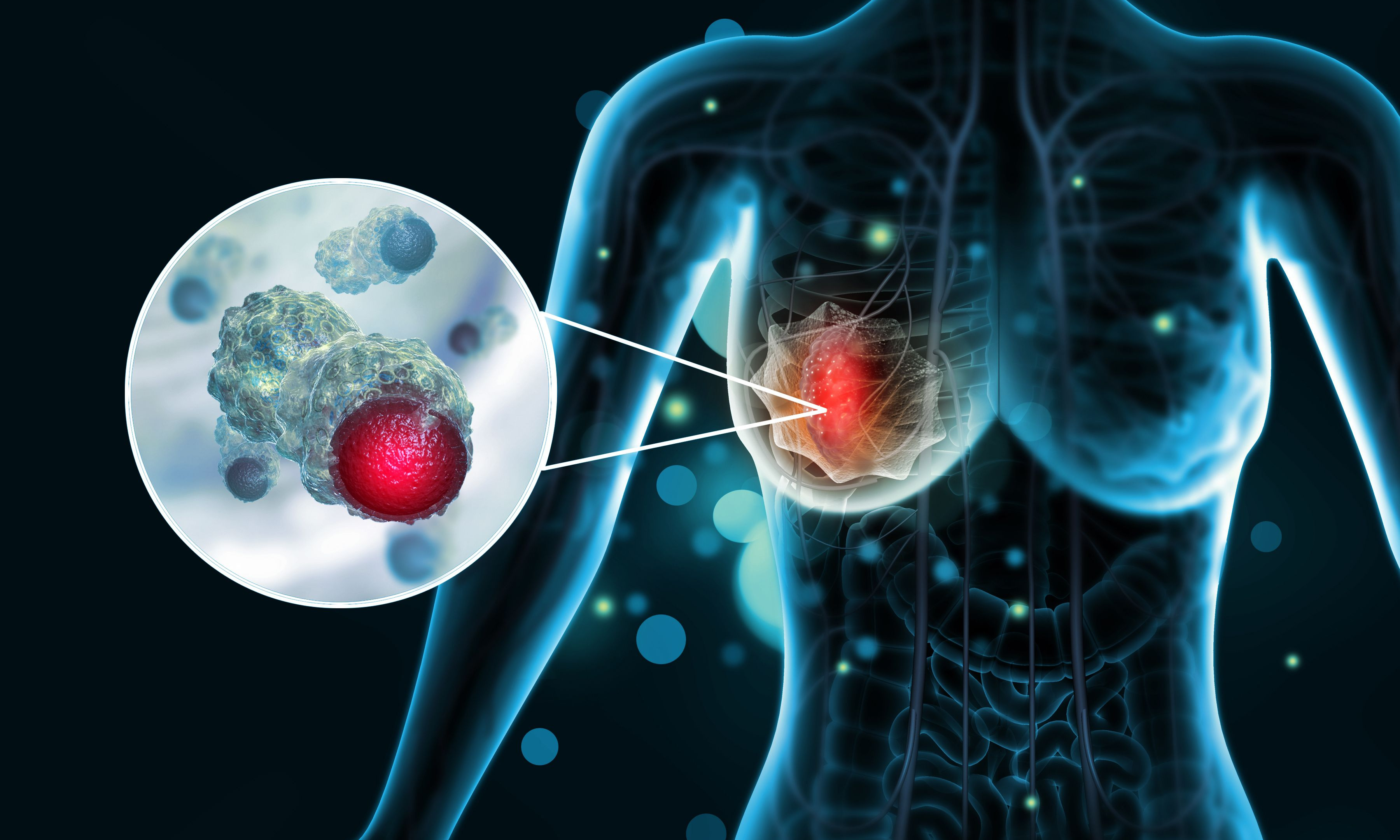 Finding Breast Cancer–Early Detection Tools - Vimarsana News