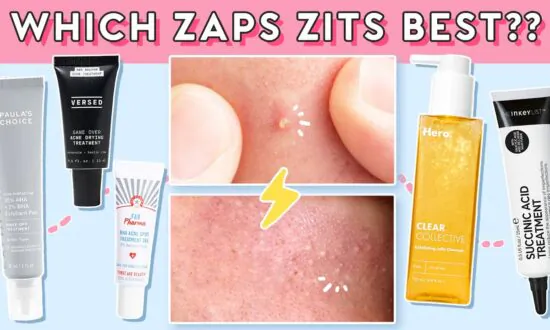 How to Take Care of Your Breakouts, Blackheads, & Whiteheads! (ft. Hero Cosmetics)