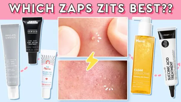 How to Take Care of Your Breakouts, Blackheads, & Whiteheads!