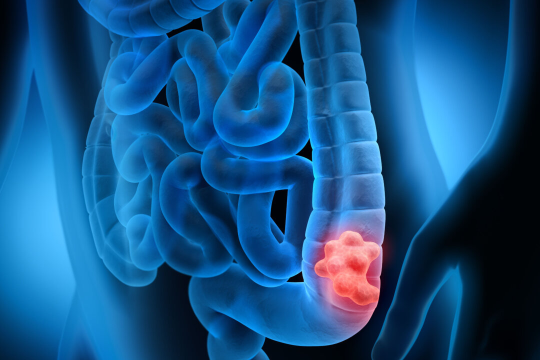 3D illustration of a body with intestinal polyp. (peterschreiber.media/Shutterstock)