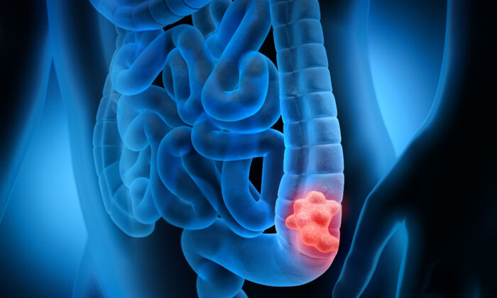 Research Finds Safer Way to Detect Colon Polyps—Better Than Colonoscopy