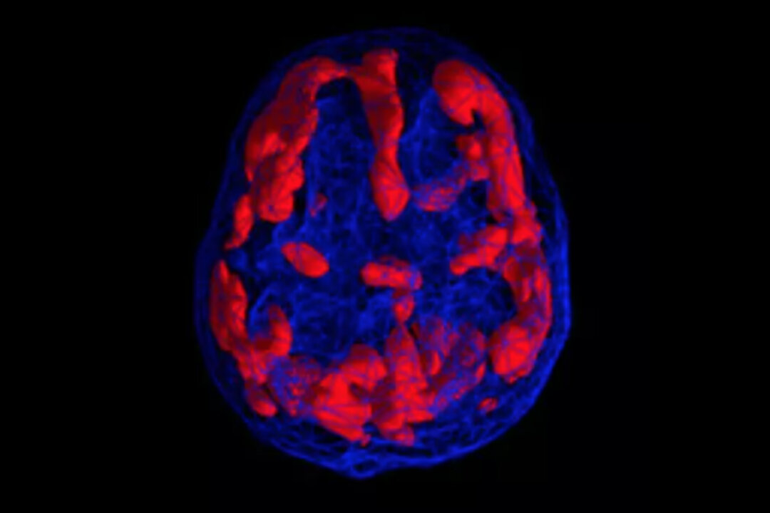 Brain SPECT imaging of Type 6 ADHD/ADD also known as "Ring of Fire" is characterized by abnormally increased activity in multiple brain regions. (Photo courtesy of Amen Clinic)