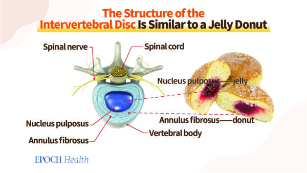 Herniated disc is like jelly being squeezed out of a donut