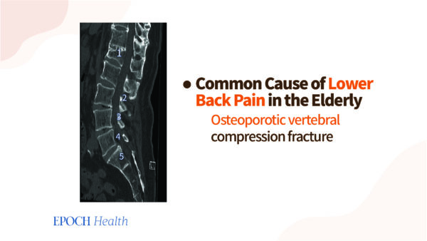 Compression fracture causes the vertebral body of the first lumbar vertebra to become wedge-shaped.