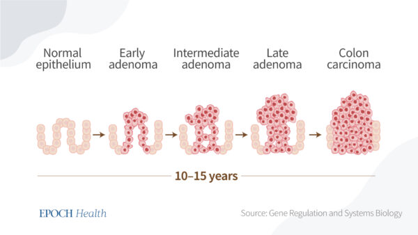 It takes 10–15 years for colon carcinoma to form. (The Epoch Times)