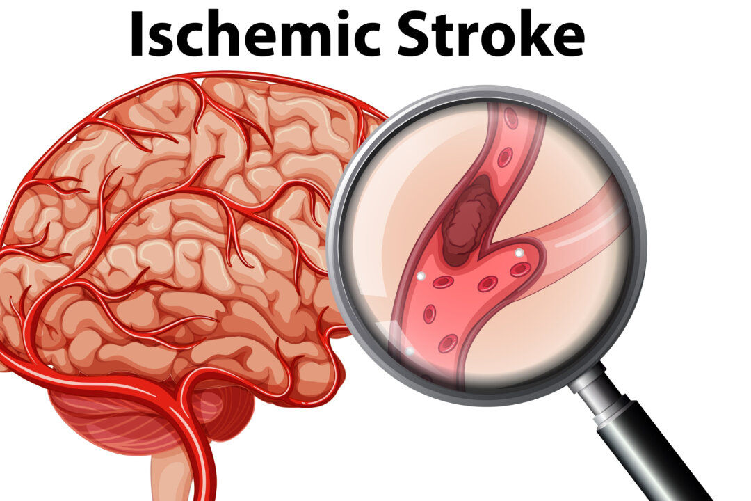 An illustration portraying an ischemic stroke. This occurs when the blood supply to part of the brain is disrupted, preventing brain tissue from getting adequate amounts of oxygen and blood. (Shutterstock)