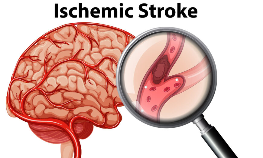 An illustration portraying an ischemic stroke. This occurs when the blood supply to part of the brain is disrupted, preventing brain tissue from getting adequate amounts of oxygen and blood. (Shutterstock)
