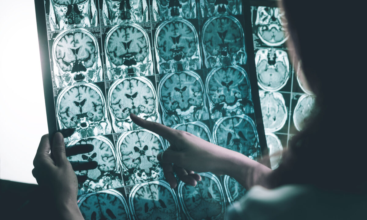 NextImg:1 Modifiable Condition to Slow Alzheimer's Disease