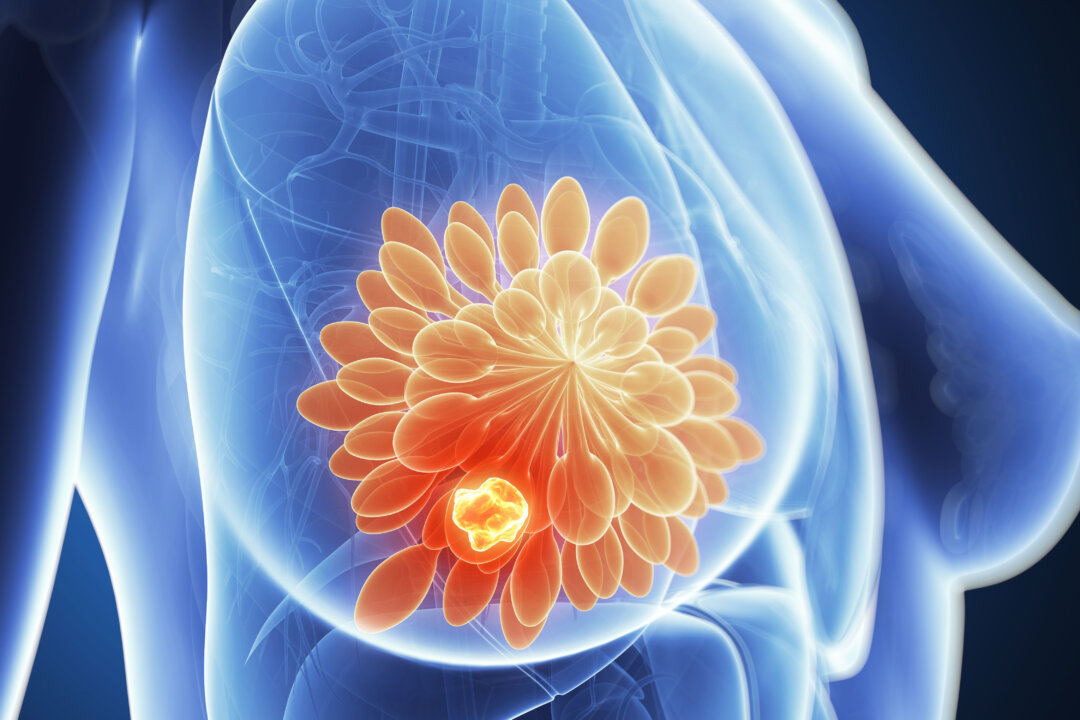 Scientists Formulate New Hydrogel to Cure Triple-Negative Breast Cancer