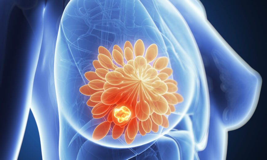 3D rendered illustration of breast cancer. (SciePro/Shutterstock)