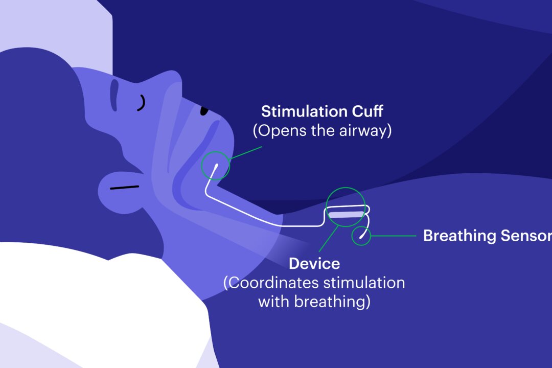 An illustration of how the implanted device works to open the airways. (Inspire Medical Systems)