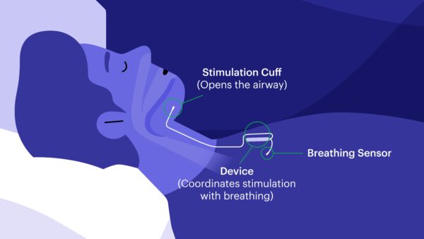 Sleep Apnea Device Works From Inside the Body