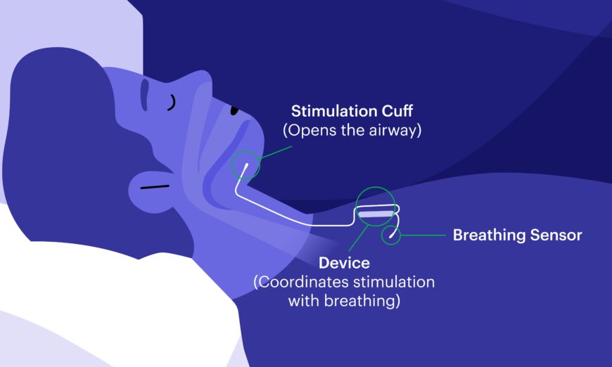 Inspire sleep apnea device