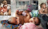 Conjoined Twins Undergo 11-Hour Separation by Team of 27 Medical Staff—Here’s How They Look Now