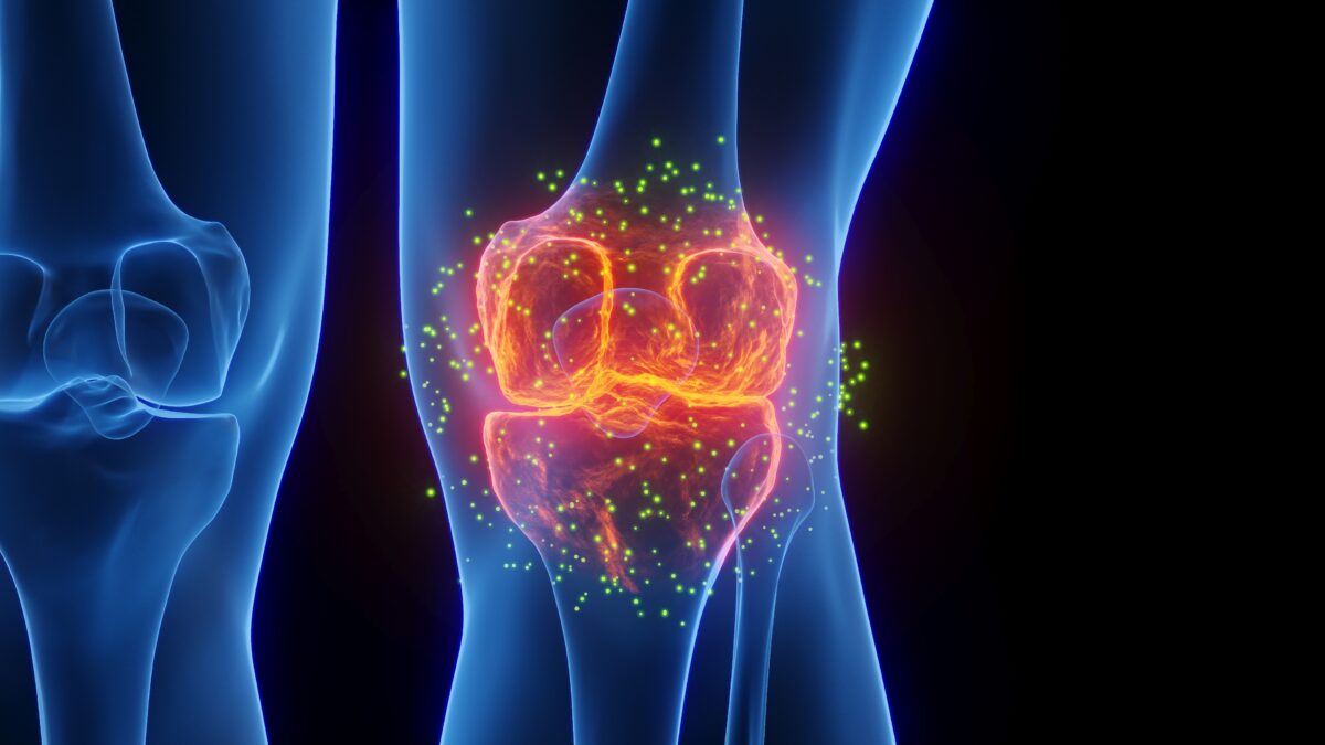 A Therapist's Guide to Preventing Chronic Knee Pain