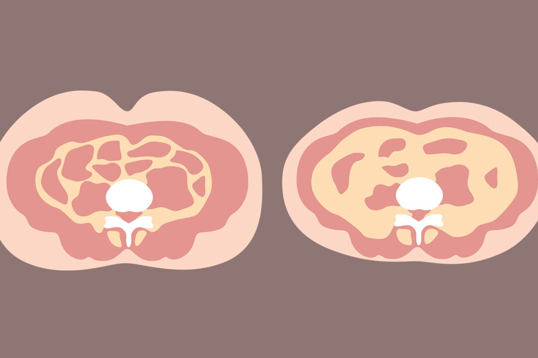 Visceral Fat May Lead to 6 Diseases Including Dementia and Cancer, 2 Traditional Ways to Remove