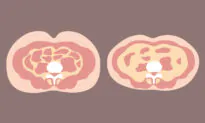 Visceral Fat May Lead to 6 Diseases Including Dementia and Cancer, 2 Traditional Ways to Remove