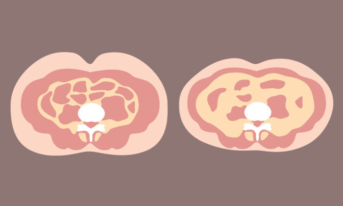 Visceral Fat May Lead to 6 Diseases Including Dementia and Cancer, 2 Traditional Ways to Remove