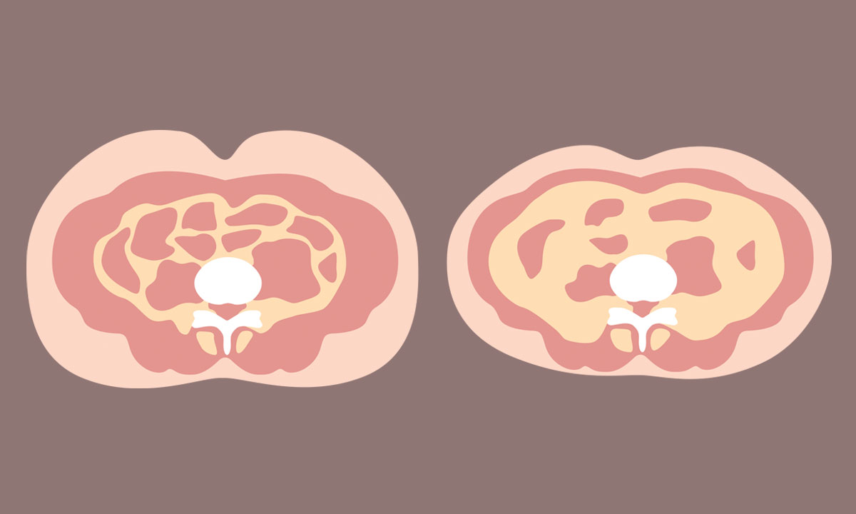 Visceral Fat May Lead to 6 Diseases Including Dementia and Cancer, 2 Traditional Ways to Remove - Vimarsana News