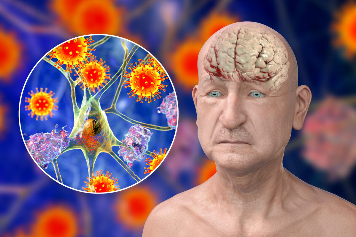 NextImg:How COVID-19 Accelerates Brain Aging and 1 Way to Protect Yourself