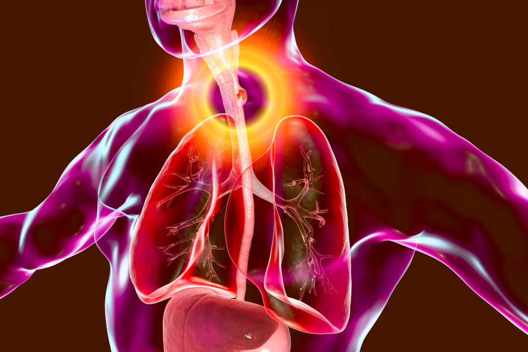 This 3D illustration shows a malignant tumor in the human esophagus. (Shutterstock)