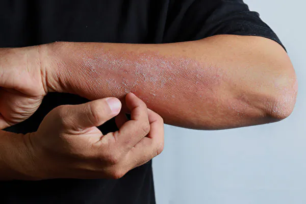 An Ancient Decoction Heals Skin Diseases