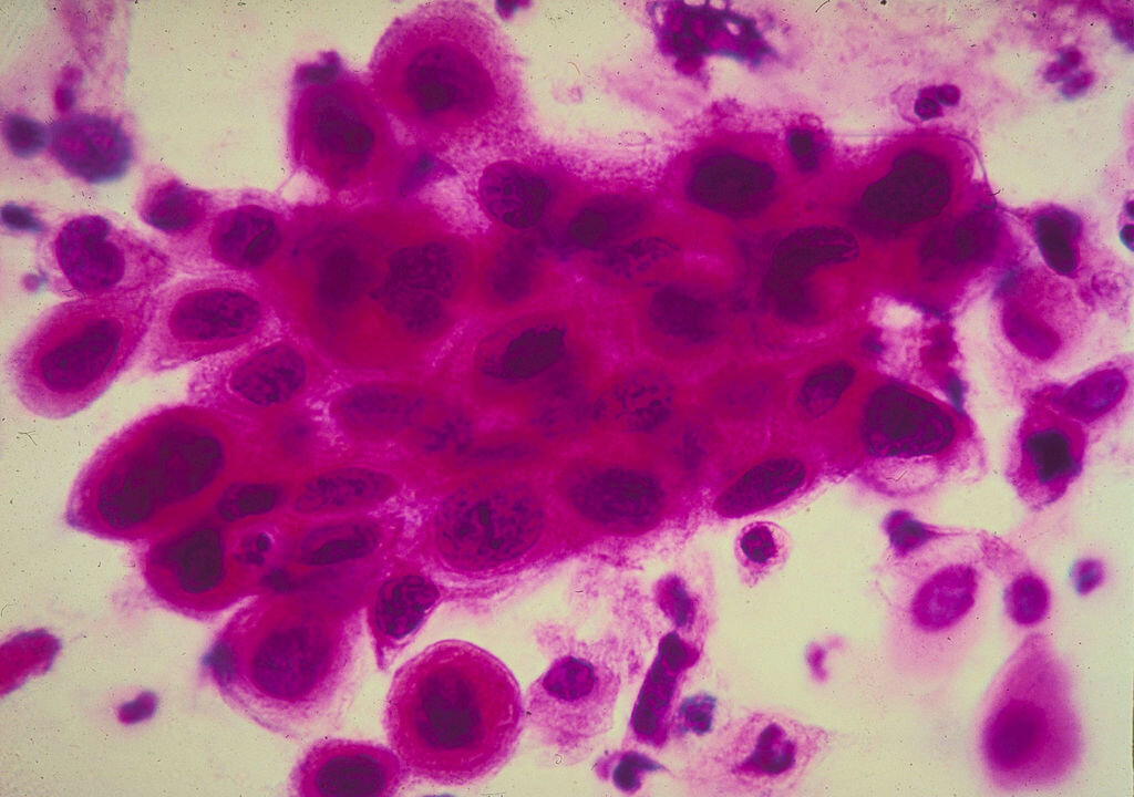 Close up of cancer cells in the cervix. Cancer of the uterine cervix, the portion of the uterus that is attached to the top of the vagina. (American Cancer Society/Getty Images)