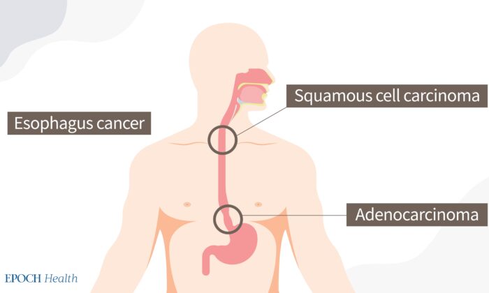 Two types of esophageal cancers. (The Epoch Times)