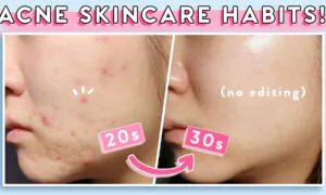 5 Skincare Tips for Acne in Your Teens, 20s, & 30s: Oily/Combination Skin Types (ft. Versed)