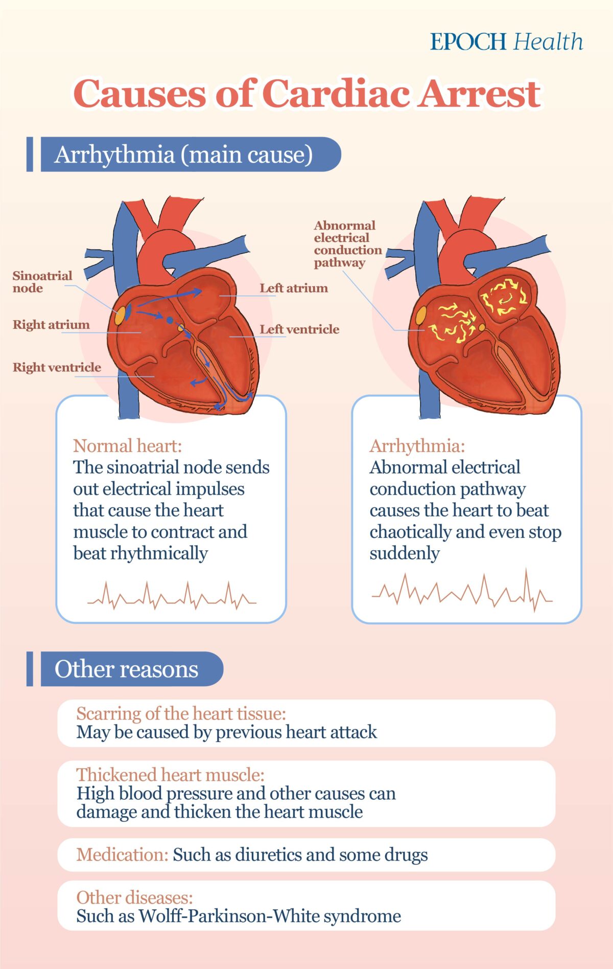 The main cause of cardiac arrest is arrhythmia, and other causes include previous heart attack and cardiomyopathy. (The Epoch Times)