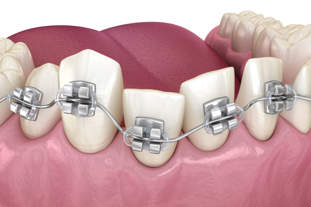 Malocclusion is not a disease, but it can cause some problems in life that require more attention. (Alex Mit/Shutterstock)