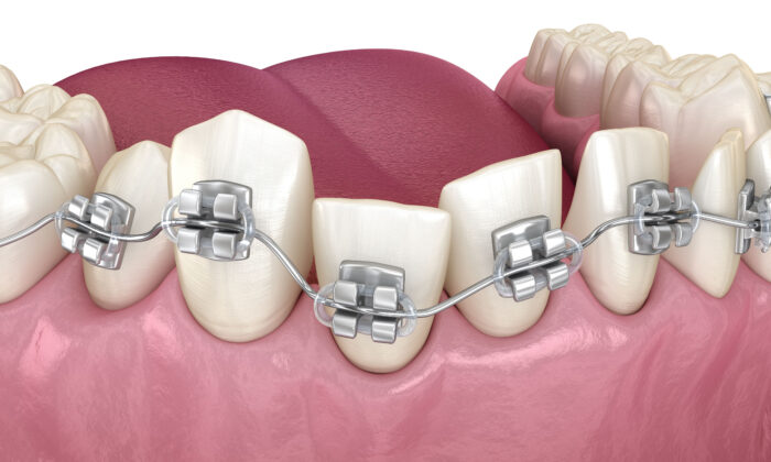 Misaligned Teeth Affect Chewing and Induce Periodontal Diseases