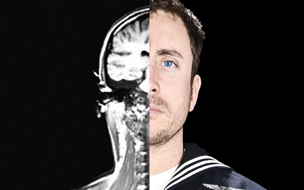 NextImg:Understanding Veteran TBI: Hormone Imbalances Following Traumatic Brain Injury