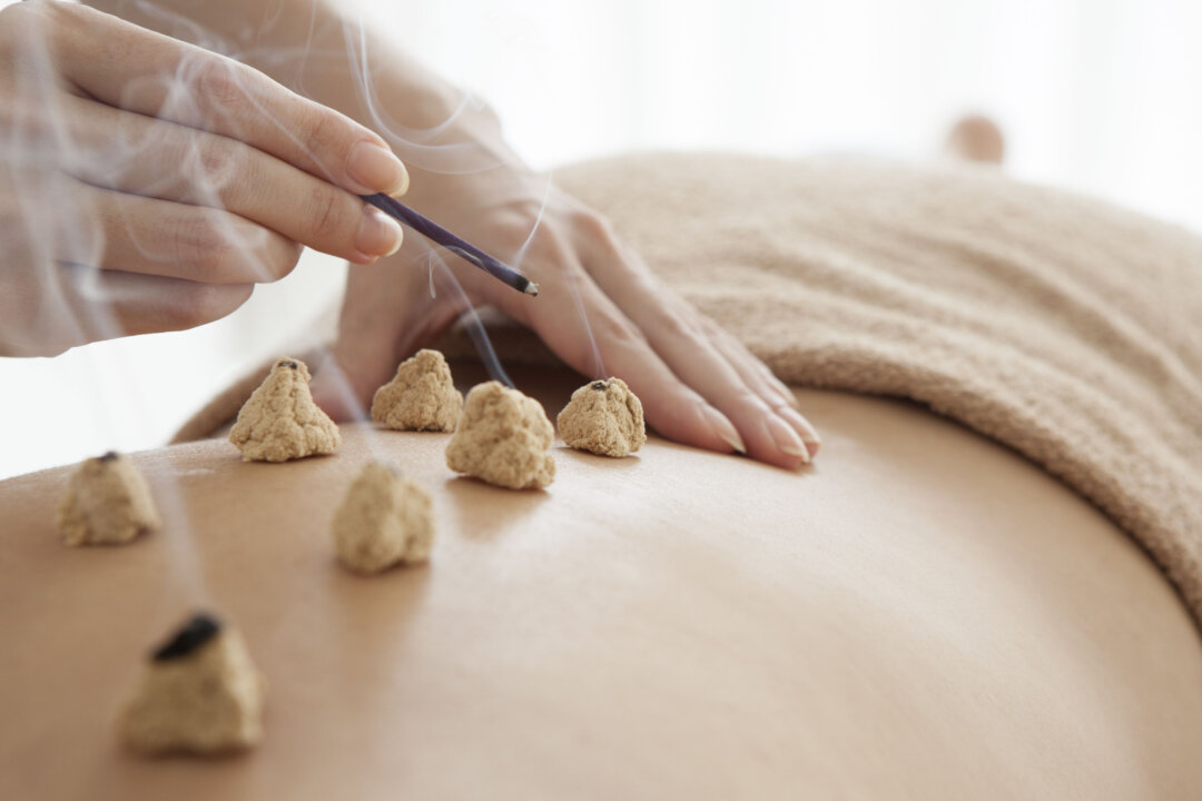Moxibustion is a form of heat therapy in which dried plant materials called “moxa” are burned on or very near the surface of the skin. In TCM, acupuncture and moxibustion are used singly or together to treat diseases. (Shutterstock)