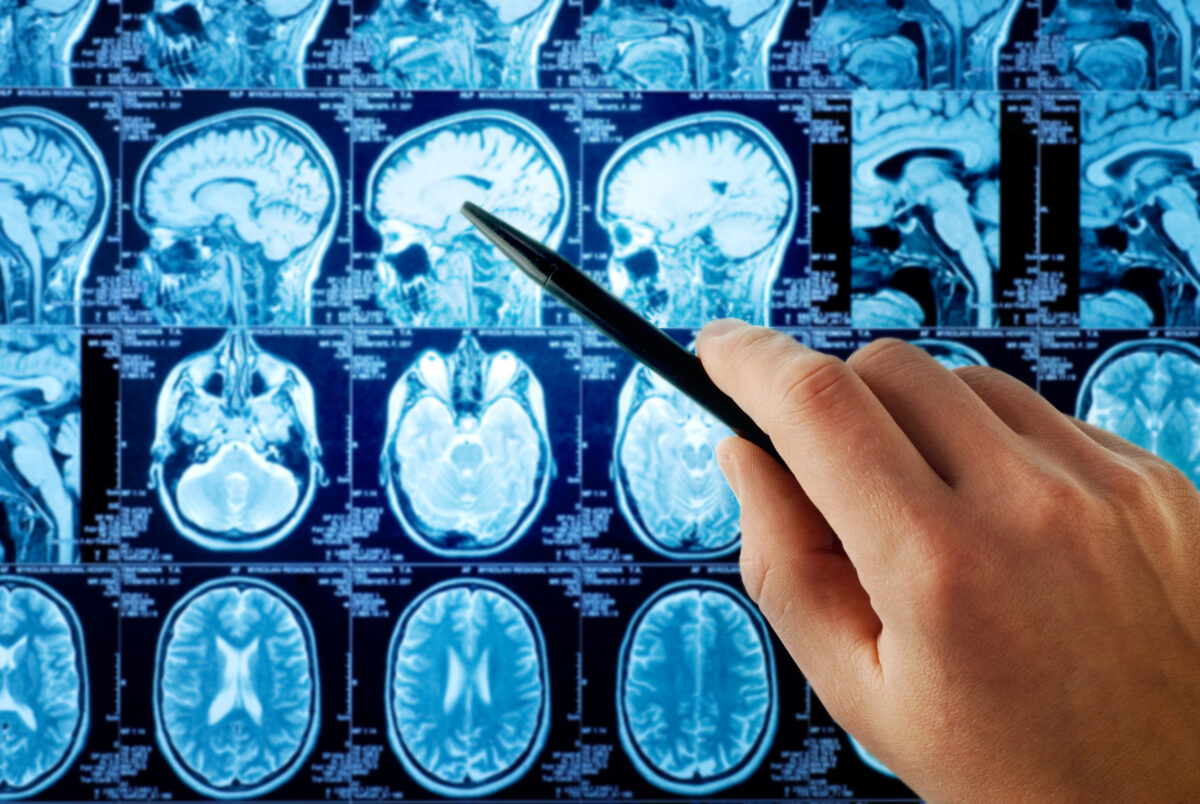NextImg:Taking Calcium Supplements Causes Brain Lesions